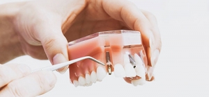 Zahnarzt Bremen Dr-Lauenstein - Implantate